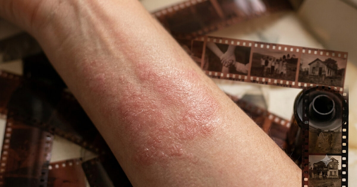 antebraço com sinais de alergia e imagens de filme fotográfico no fundo, simbolizando a história de vida por trás do sintoma alérgico